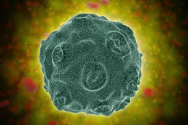 Khối u: Các khối u - dù lành tính hay ác tính - đều có thể gây suy giảm thính giác nghiêm trọng. Khối u liên quan đến thính giác phổ biến nhất là khối u thần kinh thính giác, u tế bào cận hạch thần kinh và u màng não.