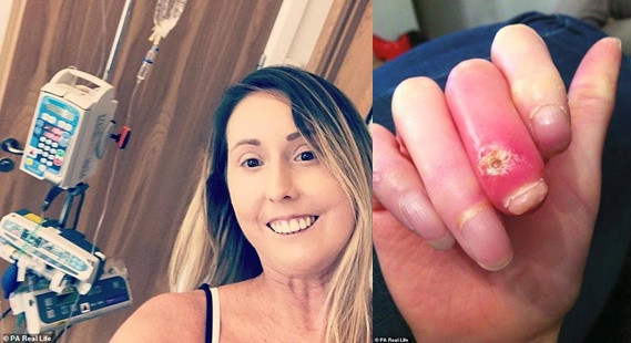 Nguoi phu nu buoc phai cat ngon tay, ngon chan 30 lan vi benh la