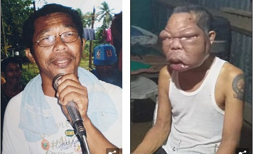 Mat bien dang, phinh to gap 3 lan binh thuong vi benh la-Hinh-2