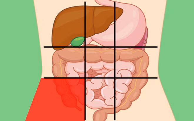 Vị trí phía dưới bên phải bụng: Phần bụng này bao gồm ruột thừa, cơ quan nhỏ lưu trữ vi khuẩn có ích, thúc đẩy quá trình tiêu hóa tốt và hỗ trợ miễn dịch. Nếu bạn bị đau nhói, chán ăn, buồn nôn, nôn và sốt, đó là những triệu chứng phổ biến của viêm ruột thừa.