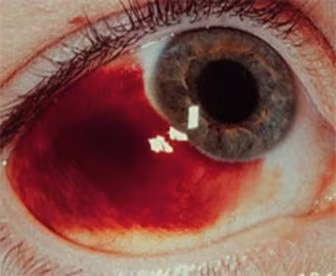 Sốt xuất huyết gây ra tình trạng xuất huyết võng mạc, làm cho các mạch máu của võng mạc bị tổn thương, máu thấm lên thành những lớp mỏng che trước võng mạc. Ở những chỗ bị che khuất đó người ta không nhìn thấy được mọi vật, thị lực của mắt bị giảm sút.