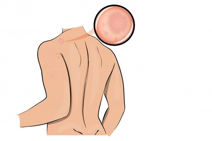 Bệnh ngoài da: Căng thẳng rất có thể sẽ gây ra các bệnh vẩy nến, mụn trứng cá và các bệnh ngoài da. Theo một nghiên cứu giữa các sinh viên của các nhà khoa học cho thấy mối liên hệ mật thiết giữa căng thẳng tâm lý cao và các vấn đề về da.