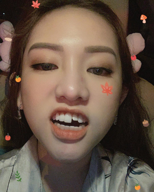 Thuy Vi nga gay rang 13 trieu dong/chiec: Nhung tai bien khi boc rang su