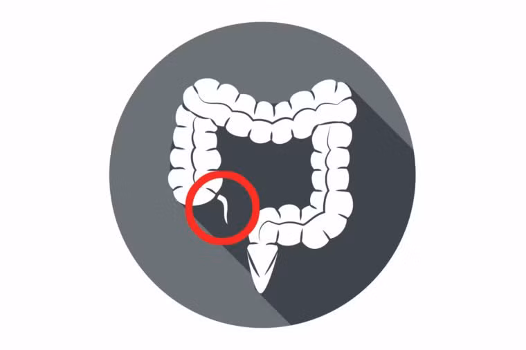 Trong một số trường hợp bệnh nặng, ruột thừa có thể bị phẫu thuật cắt bỏ. Ảnh: Shuttterstock, Internet.