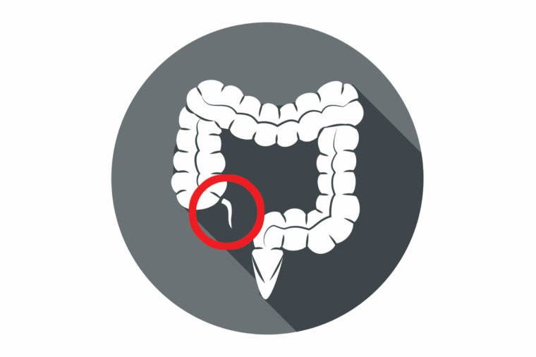 Trong một số trường hợp bệnh nặng, ruột thừa có thể bị phẫu thuật cắt bỏ. Ảnh: Shuttterstock, Internet.