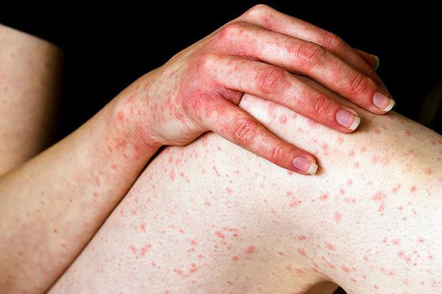 Histamine: Mặc dù là một chất dẫn truyền thần kinh thiết yếu trong cơ thể con người nhưng histamine lại gây ra phản ứng dị ứng. Một khi ăn quá nhiều các loại thực phẩm chứa histamine này sẽ khiến cho hệ hô hấp trở nên tồi tệ hơn.