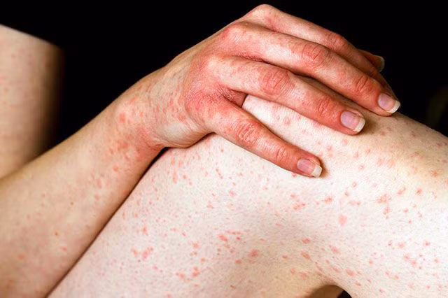 Histamine: Mặc dù là một chất dẫn truyền thần kinh thiết yếu trong cơ thể con người nhưng histamine lại gây ra phản ứng dị ứng. Một khi ăn quá nhiều các loại thực phẩm chứa histamine này sẽ khiến cho hệ hô hấp trở nên tồi tệ hơn.