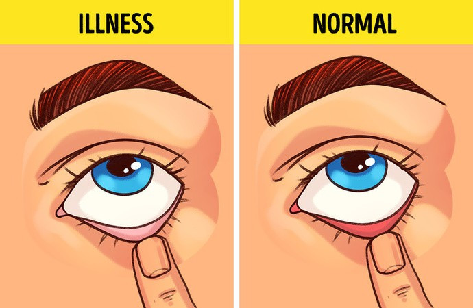 Kiểm tra nguy cơ thiếu máu: Kéo mí mắt dưới của bạn xuống. Nếu thấy trong mắt là màu hồng thì mọi thứ đều ổn. Còn nếu bạn bị thiếu máu, màu sắc trong mí mắt có thể là màu hồng nhạt hoặc thậm chí là màu vàng.