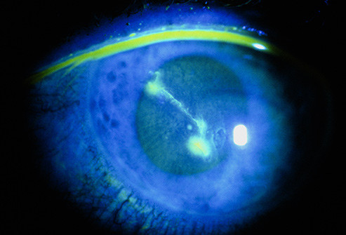 Xước mắt: Bụi, cát và kính áp tròng có thể làm xước giác mạc, khiến mắt bạn đỏ, đau, chảy nước mắt nhiều và nhạy cảm với ánh sáng. Dù các vết xước này thường tự khỏi trong hai ngày, bạn nên đến bác sĩ để đảm bảo không bị nhiễm trùng.