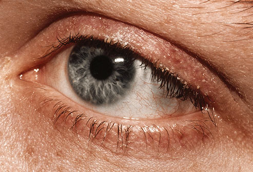 Viêm mí mắt: Tình trạng này khiến mí mắt sưng, mắt có cảm giác châm chích và chảy nước, đỏ, ngứa. Nguyên nhân có thể là do nhiễm trùng, chứng đỏ mặt (roseacea) hoặc dị ứng. Tình trạng này thường tự biến mất, nhưng bạn có thể điều trị để nhanh khỏi hơn.