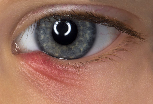 Tắc tuyến lệ: Thông thường, nước mắt chảy ra từ tuyến lệ bên trên mắt, tràn ra bề mặt nhãn cầu và chảy vào các tuyến ở khóe mắt. Nhưng nếu các tuyến này bị tắc, nước mắt sẽ đọng lại và khiến mắt bạn ướt. Có nhiều nguyên nhân gây ra tình trạng này, như nhiễm khuẩn, chấn thương, thậm chí lão hóa.