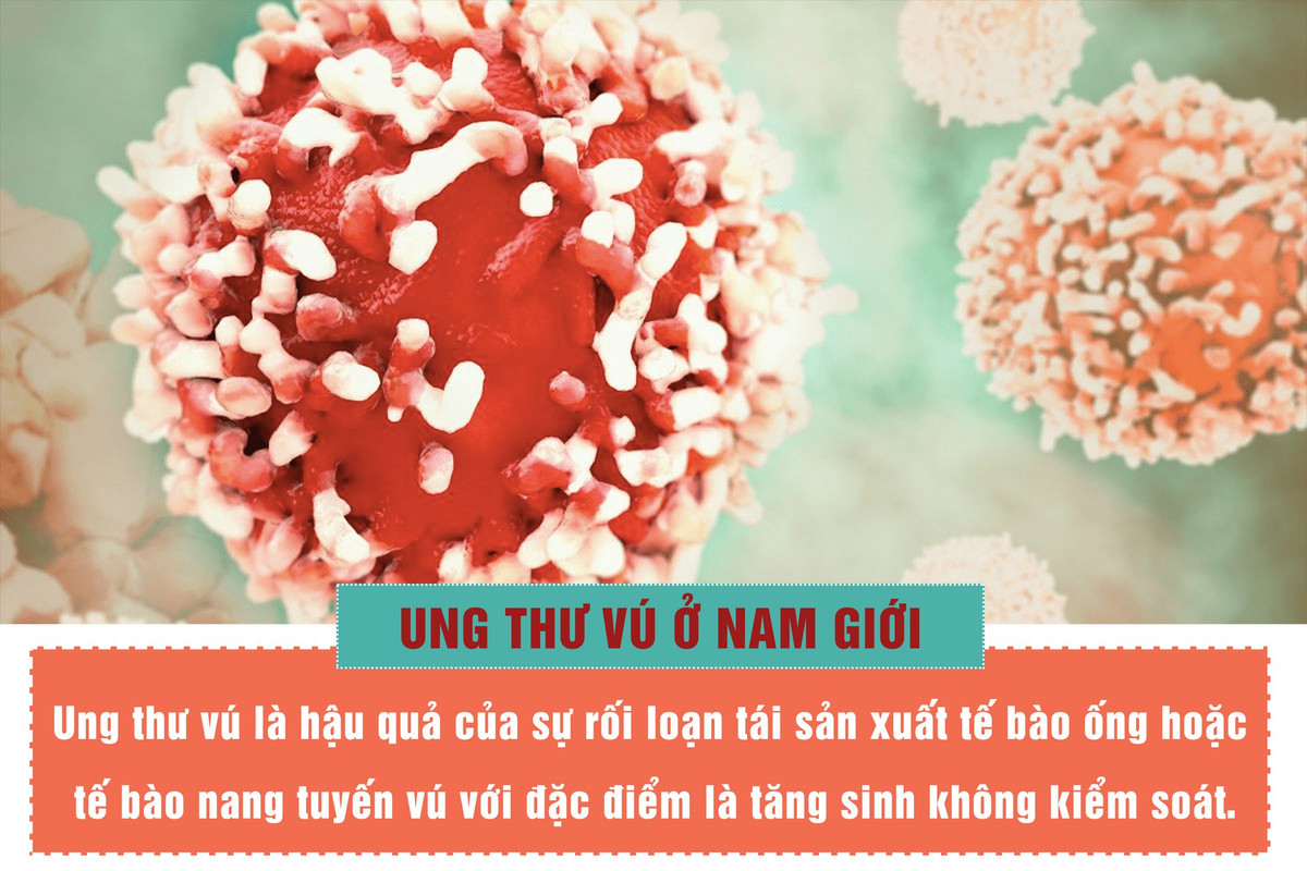 Nam gioi dung bo qua khi thay khoi u duoi nguc-Hinh-2