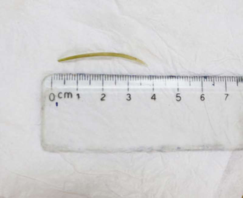 Kinh hai nhung truong hop nhap vien nguy kich vi hoc xuong ca