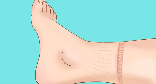 Sưng ở khu vực chân: Khi tim không hoạt động tốt, chất lỏng từ mạch máu rò rỉ vào các mô xung quanh. Khi đó, chân và bàn chân là nơi phổ biến nhất bị ảnh hưởng do trọng lực tập trung ở đây. Triệu chứng này gọi là phù ngoại biên.