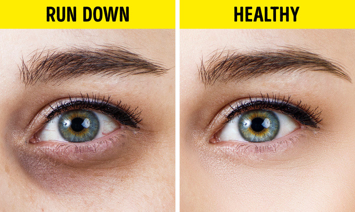 Quầng thâm quanh mắt hình vòng tròn: Quầng thâm dưới mắt thể hiện những vấn đề bất cập trong việc sinh hoạt. Ngủ không đủ giấc, chế độ ăn uống kém hoặc lối sống không lành mạnh khiến các mô mỡ quanh mắt thay đổi, da trở nên mỏng và dễ xuất hiện quầng thâm, nếp nhăn. Bạn cần thay đổi lối sống để cải thiện tình trạng. Ảnh: BS.