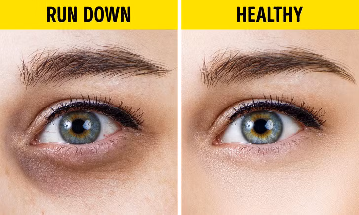 Quầng thâm quanh mắt hình vòng tròn: Quầng thâm dưới mắt thể hiện những vấn đề bất cập trong việc sinh hoạt. Ngủ không đủ giấc, chế độ ăn uống kém hoặc lối sống không lành mạnh khiến các mô mỡ quanh mắt thay đổi, da trở nên mỏng và dễ xuất hiện quầng thâm, nếp nhăn. Bạn cần thay đổi lối sống để cải thiện tình trạng. Ảnh: BS.