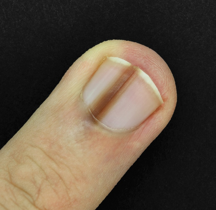 Sọc đen trên móng tay: Bất kỳ thay đổi nào trên móng tay, kể cả việc tự nhiên móng dày lên hay mỏng đi, đều có liên quan đến vấn đề sức khỏe. Khi thấy xuất hiện đường sọc đen tối màu trên móng mà không phải do bị kẹp tay, bạn cần tới gặp bác sĩ sớm bởi đó có thể là dấu hiệu của khối u ác tính.