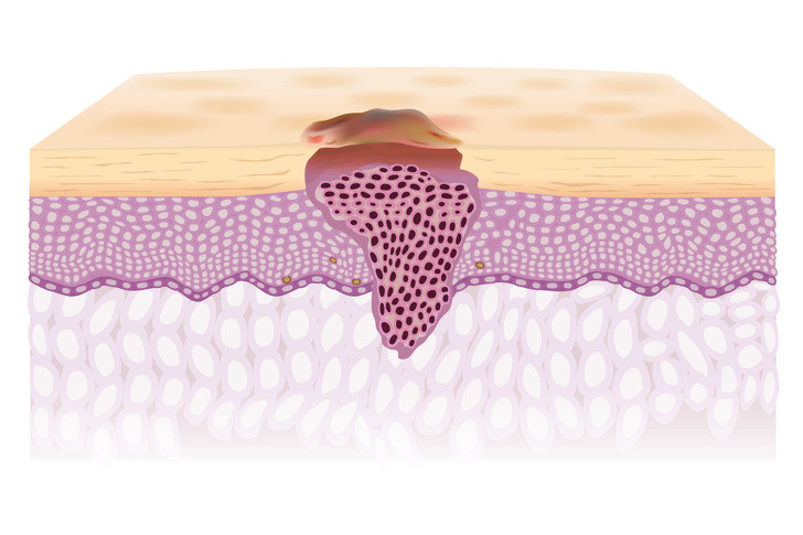 Mụn lâu lành: Nếu bạn gặp tình trạng mụn sưng đỏ trong thời gian dài, dễ chảy máu và rất lâu lành, bạn nên kiểm tra xem nó có thể là dấu hiệu của ung thư biểu mô tế bào đáy. Mặc dù nghe có vẻ đáng sợ nhưng loại ung thư da này ít rủi ro nhất, không lây lan và có thể được điều trị tương đối nhanh chóng khi phát hiện sớm.