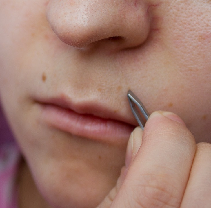 Nữ giới mọc lông bất thường: Nếu lông đột nhiên mọc ở một số khu vực như trên môi, quanh cằm hoặc dưới rốn của bạn, đó có thể là triệu chứng của hội chứng buồng trứng đa nang (PCOS) do mất cân bằng nội tiết tố.