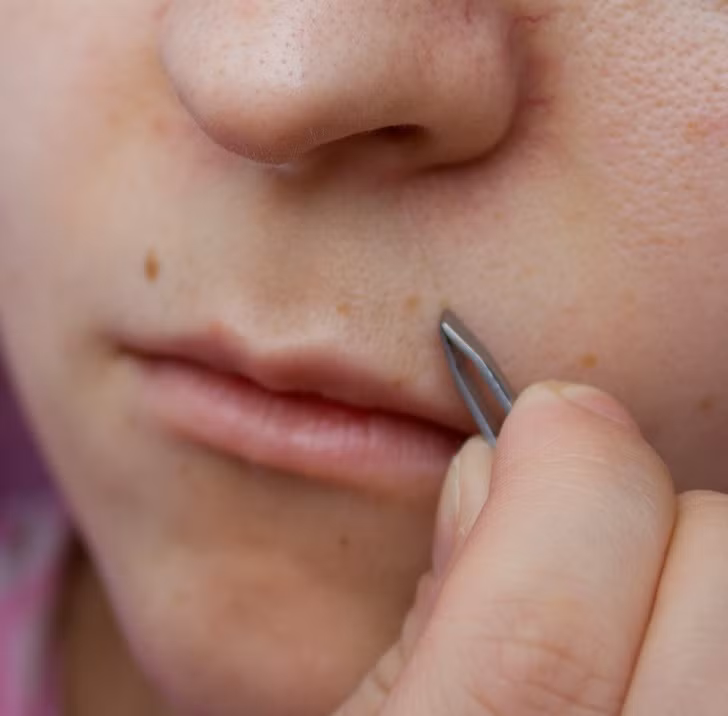 Nữ giới mọc lông bất thường: Nếu lông đột nhiên mọc ở một số khu vực như trên môi, quanh cằm hoặc dưới rốn của bạn, đó có thể là triệu chứng của hội chứng buồng trứng đa nang (PCOS) do mất cân bằng nội tiết tố.