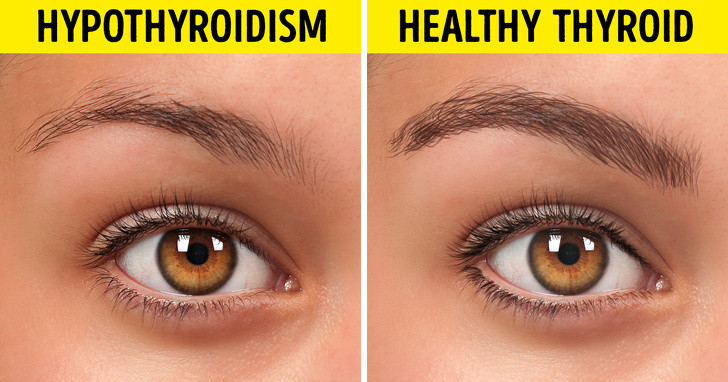 Lông mày mỏng: Lông mày tự nhiên mỏng đi có thể là dấu hiệu của bệnh suy giáp. Nếu tuyến giáp không hoạt động bình thường, nó có thể sản xuất quá nhiều hoặc không đủ một loại hormone cụ thể và cả hai tình trạng này đều gây ra tình trạng tóc và lông mỏng trên cơ thể.