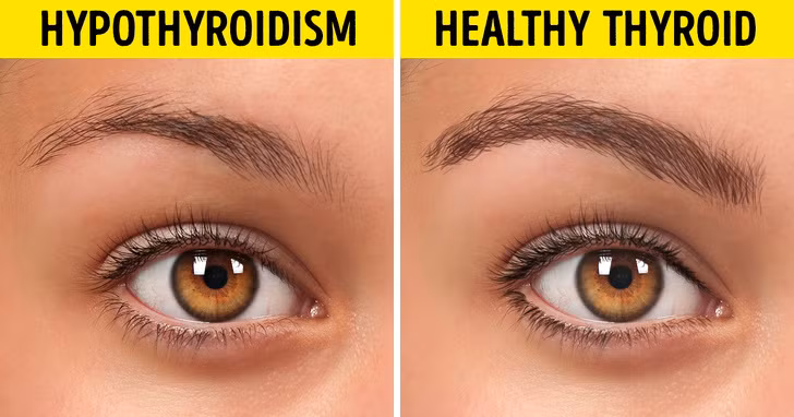 Lông mày mỏng: Lông mày tự nhiên mỏng đi có thể là dấu hiệu của bệnh suy giáp. Nếu tuyến giáp không hoạt động bình thường, nó có thể sản xuất quá nhiều hoặc không đủ một loại hormone cụ thể và cả hai tình trạng này đều gây ra tình trạng tóc và lông mỏng trên cơ thể.