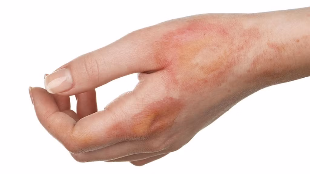 Thuốc bỏng: Trong những ngày Tết, nhu cầu nấu nướng của các gia đình đều gia tăng. Ngoài ra cũng không loại trừ một số nguy cơ bỏng do bô xe, xoong nồi nóng, than lửa,… Cho nên ngoài việc tìm hiểu cách sơ cứu cơ bản, bạn nên mua thêm các loại thuốc trị bỏng đề phòng như Pantenol dạng kem bôi hoặc dạng xịt.