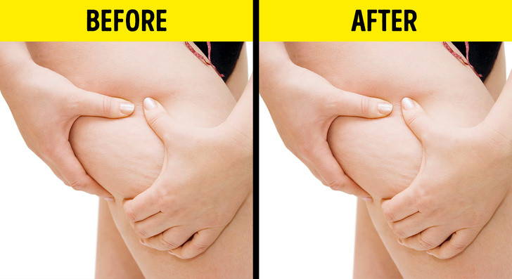 Kem chống da sần vỏ cam: Trên thực tế, kem chống sần vỏ cam không mang đến hiệu quả như tên gọi. Theo nghiên cứu, vấn đề về da này chỉ là một đặc điểm tự nhiên trên cơ thể một số người. Sự xuất hiện của lớp sần vỏ cam không phụ thuộc vào việc giảm hoặc tăng cân, mà bắt nguồn từ hormone và gen.