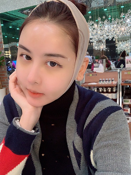 Hà Lade không chỉ công khai việc chi 300 triệu đồng để sang Hàn Quốc phẫu thuật thẩm mỹ mà còn ghi lại nhật ký "dao kéo" hàng ngày. Trong lần chỉnh sửa nhan sắc này, cô nàng chọn cách hạ gò má, cấy má baby để lấy lại vẻ tươi trẻ. Ảnh: Internet, FBNV.