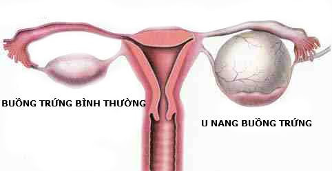 Tuong con gai dau bung do roi loan tieu hoa, me choang vang biet su that