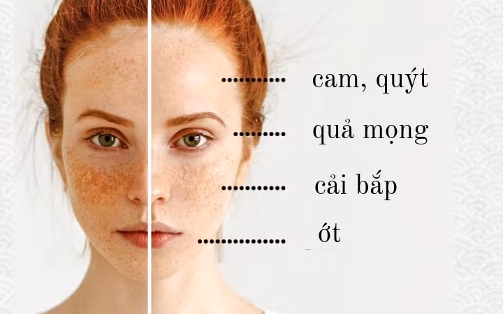 Da tàn nhang: Da bị tăng sắc tố có thể do bạn thiếu vitamin, đặc biệt là B12. Chế độ ăn giàu vitamin B12, C và E cùng các chất chống oxy hóa như axit ellagic có thể giúp bạn thoát khỏi các đốm sắc tố. Các loại trái cây như: cam quýt, dâu tây, kiwi, cà chua và lựu rất giàu những loại vitamin hữu ích này.