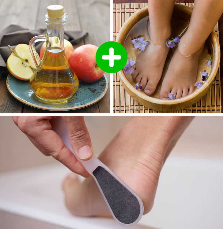 Ngâm giấm táo: Giấm táo giết chết các vi khuẩn, làm mềm da và loại bỏ mùi hôi chân. Đổ đầy một chậu nước ấm (4 phần) và thêm một phần giấm táo. Ngâm trong 20 phút. Sau khi ngâm xong, hãy chà nhẹ gót chân bằng đá bọt.