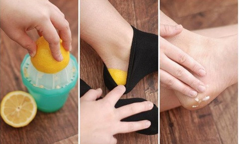 Đắp miếng chanh: Đây là một trong những biện pháp trị gót chân khô, nứt nẻ tốt nhất. Cắt đôi một quả chanh lớn rồi vắt bỏ nước đi. Đặt miếng chanh vừa vắt nước úp vào gót chân của bạn và sau đó đi tất. Để trong 30 phút. Sau đó bỏ vỏ chanh đi và bôi dầu dừa vào gót chân.