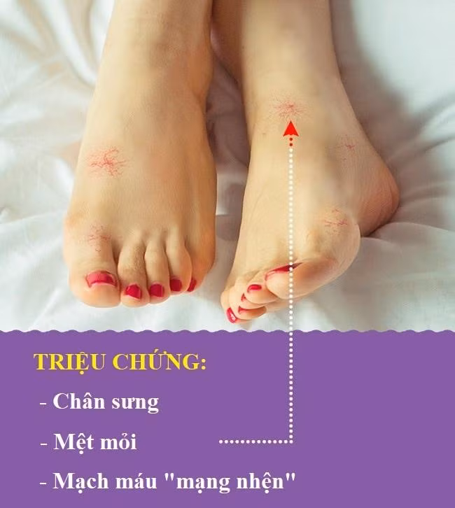 Vấn đề về gan: Theo Mayo Clinic, bạn có thể phát hiện sớm vấn đề ở gan bằng cách chú ý tới tình trạng của đôi chân. Nếu gan hoạt động bất thường, các chi bắt đầu sưng lên và mạch máu hình "mạng nhện" bắt đầu xuất hiện. Nó xảy ra khi lưu lượng máu vận chuyển giữa ruột, lá lách, tuyến tụy và gan gặp vấn đề.