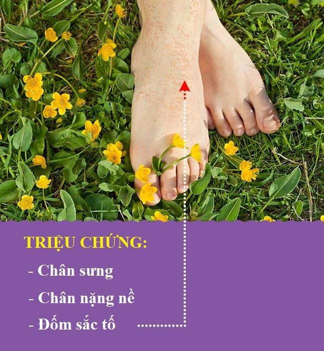 Suy tĩnh mạch: Khi bạn bị suy tĩnh mạch, máu di chuyển từ tay chân đến tim khó khăn hơn. Điều này xảy ra khi van tĩnh mạch yếu hoặc bị tổn thương. Nó có thể gây ra sưng, dữ dội nhất ở khu vực mắt cá chân. Bạn cũng cảm thấy chân sưng đau nặng nề và xuất hiện các đốm sắc tố trên chân.