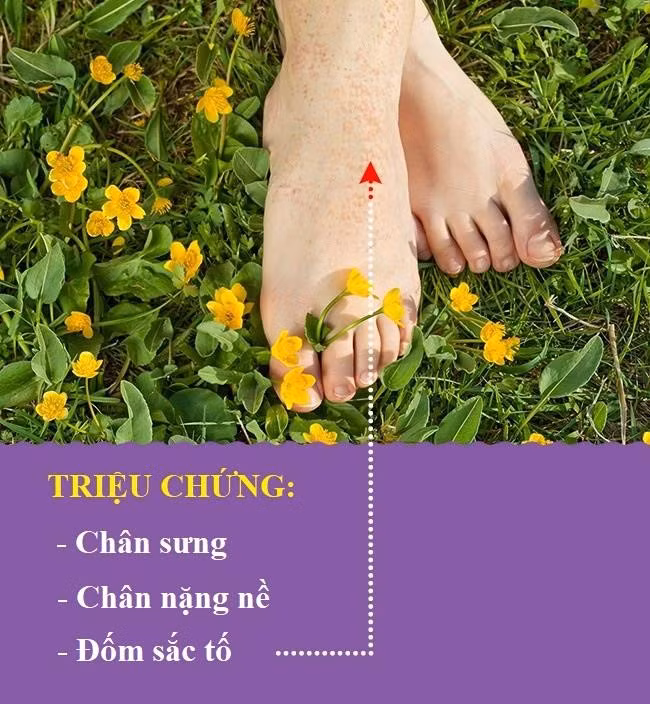 Suy tĩnh mạch: Khi bạn bị suy tĩnh mạch, máu di chuyển từ tay chân đến tim khó khăn hơn. Điều này xảy ra khi van tĩnh mạch yếu hoặc bị tổn thương. Nó có thể gây ra sưng, dữ dội nhất ở khu vực mắt cá chân. Bạn cũng cảm thấy chân sưng đau nặng nề và xuất hiện các đốm sắc tố trên chân.