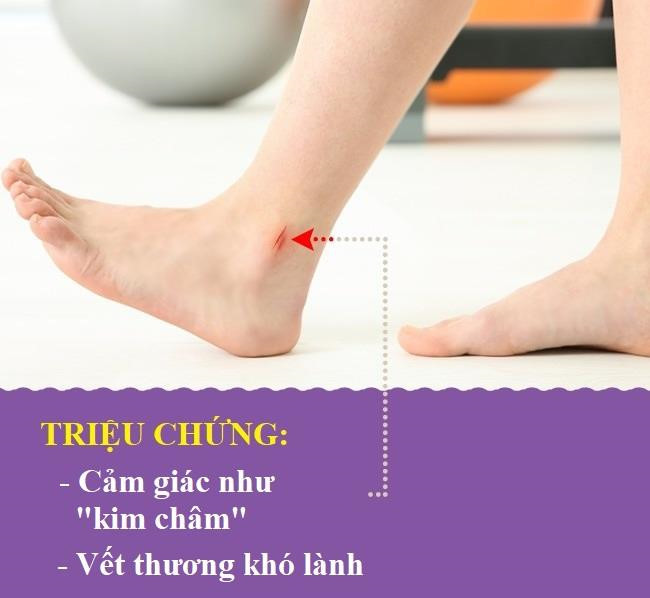 Bệnh tiểu đường: Theo Health Line, khi bạn bị tiểu đường, ngay cả những vết thương nhỏ ở chân cũng có thể gây ra hậu quả nghiêm trọng. Thậm chí, một vết bầm nhỏ trên chân cũng có thể bị loét. Nó gây ra triệu chứng đau, tê như kim châm ở chân. Bệnh này thường đi kèm với tổn thương thần kinh.
