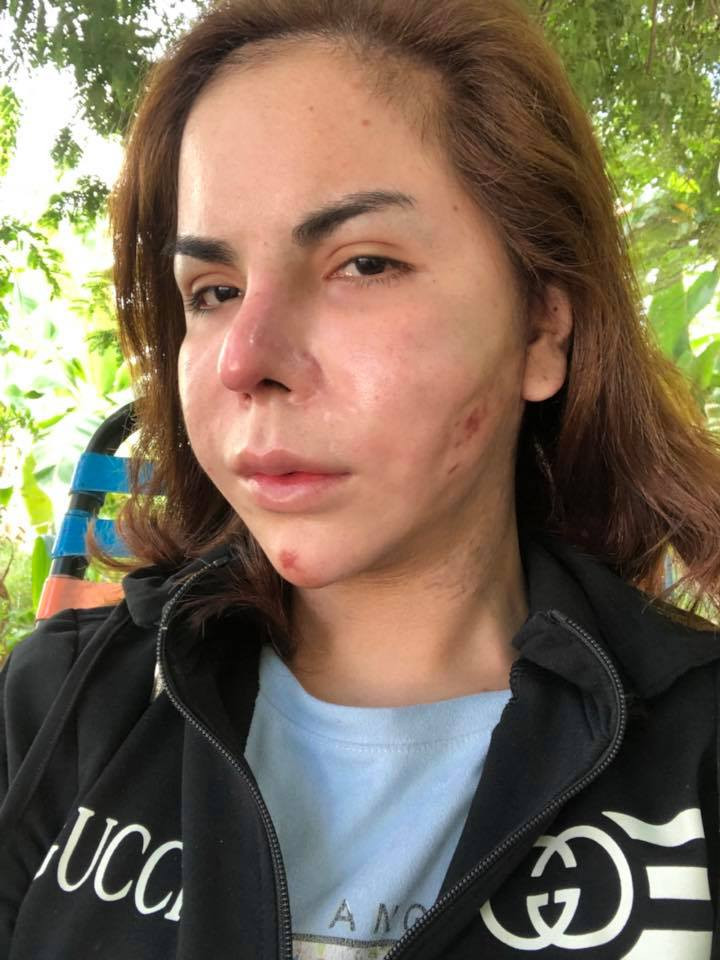 Qua hình ảnh có thể nhận thấy, sau khi nạo lớp silicon, gương mặt của Linda đã "hỏng" tới 70%.