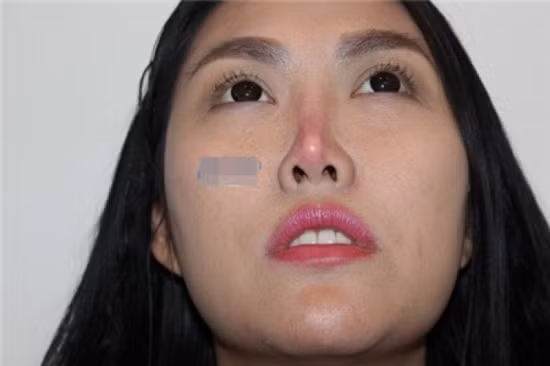 Đầu năm 2015, "nữ hoàng dao kéo" cho biết cô đang trải qua những tháng ngày vô cùng lo lắng do hậu quả của việc lạm dụng thẩm mỹ từ 10 năm trước. Chiếc mũi sửa của cô đang bị biến dạng, lệch sang một phía. Còn đầu mũi thì sưng tấy và có nguy cơ hoại tử.