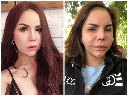 Hot girl chuyển giới nổi tiếng Sài Thành Linda cũng từng gây sốc khi chia sẻ loạt ảnh mặt biến chứng nặng nề của việc thẩm mỹ.