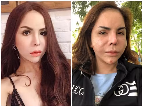 Hot girl chuyển giới nổi tiếng Sài Thành Linda cũng từng gây sốc khi chia sẻ loạt ảnh mặt biến chứng nặng nề của việc thẩm mỹ.