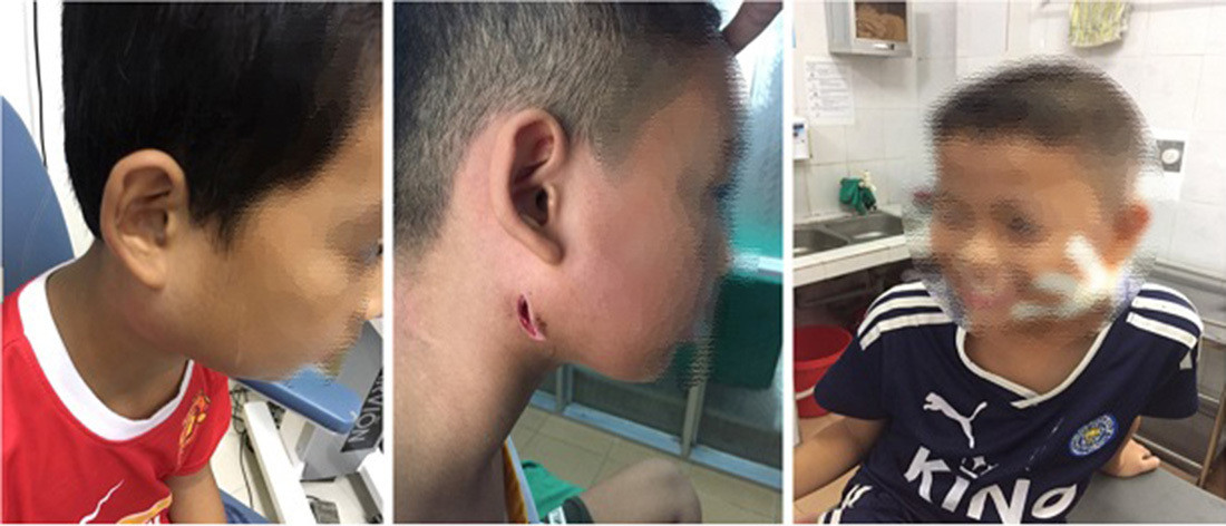 Nhung truong hop bi vi khuan “an thit nguoi” tan cong kinh hoang o VN-Hinh-2