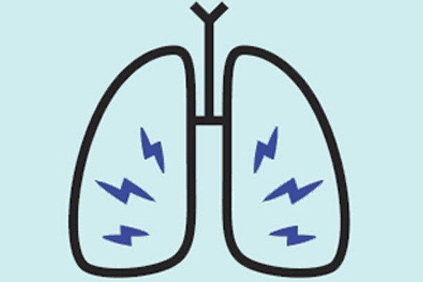 Nhiễm khuẩn mãn tính: Trong hầu hết các trường hợp, vi khuẩn và virus là nguyên nhân gây các bệnh nhiễm khuẩn phổi như viêm phế quản hay viêm phổi. Tuy nhiên, nếu bạn liên tục bị ốm và mọi cơn bệnh đều đi vào phổi, đó có thể là dấu hiệu của bệnh ung thư phổi. Sự nhiễm khuẩn có thể do chính khối u gây ra, hoặc do hệ miễn dịch suy yếu.