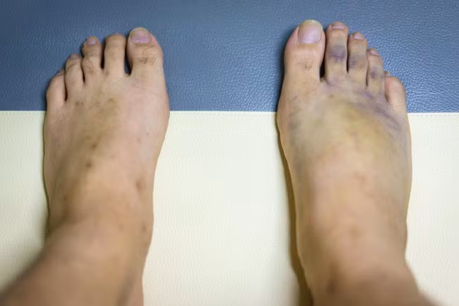 3. Có vết bầm quanh mắt cá chân và chân: Nếu bạn có vết bầm tím xung quanh những khu vực này hoặc nếu da quanh khu vực đó mất nhiều thời gian để trở lại bình thường sau khi ấn, điều đó có nghĩa là bạn đã mất rất nhiều protein và natri do bị suy thận. Ảnh: Internet.