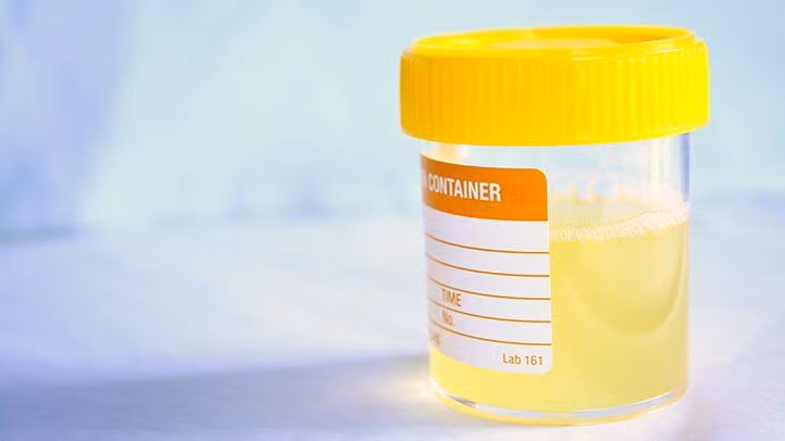 5. Nước tiểu nhiều bọt: Khi điều này xảy ra, nó có nghĩa là protein đã rò rỉ vào nước tiểu của bạn do thận không hoạt động như bình thường. Ảnh: Everyday Health.