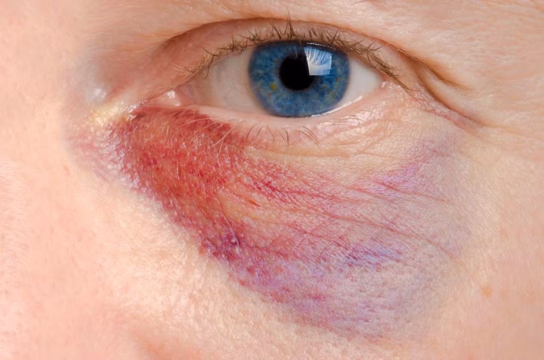 2. Có vết bầm quanh mắt: Những vết bầm tím có thể xuất hiện vì mất protein được lưu trữ trong máu nhưng đã bị thận lọc bỏ. Ảnh: MNT.