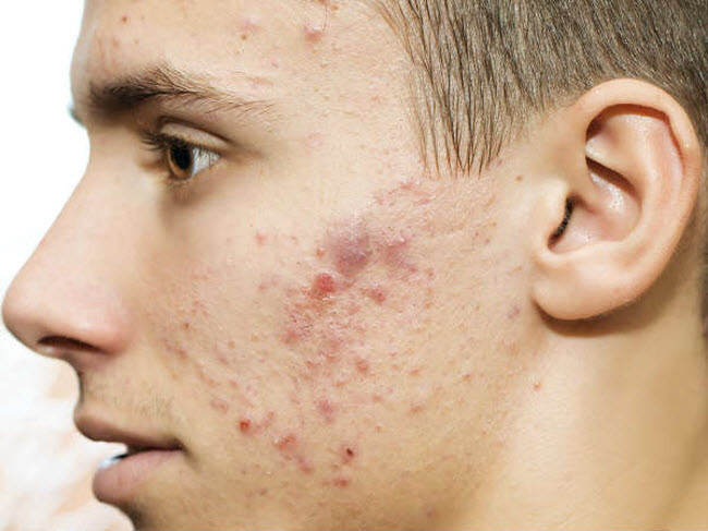 Mặt mọc mụn trứng cá: Tuổi dậy thì là thời kỳ mặt xuất hiện nhiều mụn trứng cá nhất. Nên nếu bạn vẫn đối mặt với tình trạng này khi đã trưởng thành, thì bạn có thể đang ăn quá nhiều đồ ngọt hàng ngày. Vì thủ phạm thực sự gây ra mụn trứng cá là đường.