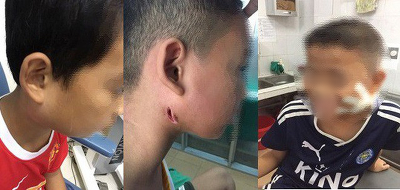 Thông tin từ Bệnh viện Sản Nhi Nghệ An cho biết, từ tháng 7-9/2019, bệnh viện đã phát hiện và điều trị cho 3 trẻ mắc bệnh Whitmore. Theo đó, 3 bệnh nhân gồm em Nghiêm Thanh T. (SN 2005, trú huyện Đức Thọ, Hà Tĩnh), em Hoàng Văn Cao (SN 2009, trú huyện Thanh Chương, Nghệ An) và em Nguyễn Công H. (SN 2010, trú huyện Yên Thành, Nghệ An). Ảnh: Vietnamnet.