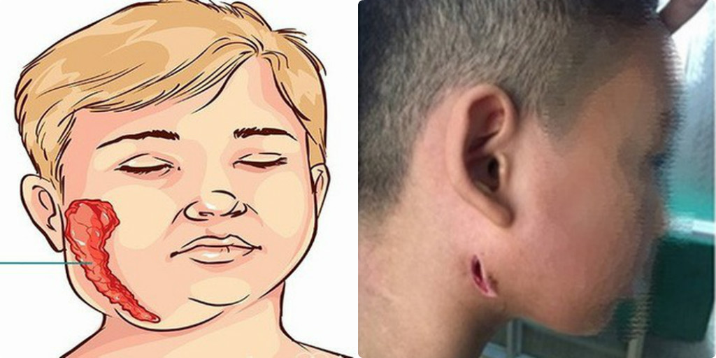 Lúc nhập viện, 3 bệnh nhi đều bị áp xe viêm tuyến nước bọt màng tai. Khi cấy mủ, xét nghiệm máu thì phát hiện dương tính với Whitmore. Sau khi được điều trị 50 ngày, em T. đã xuất viện, còn 2 em C. và H. hiện vẫn đang theo dõi và điều trị tại Khoa Tai Mũi Họng, BV Sản Nhi Nghệ An. Ảnh: Internet.