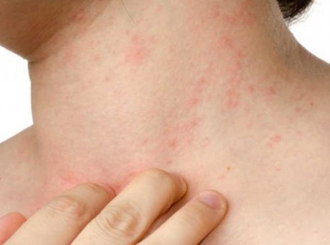 Nang nong 40 do gay hai gi cho suc khoe va nen an mac the nao?-Hinh-4